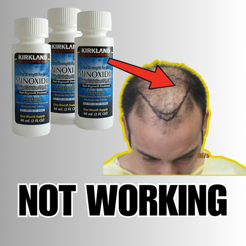 Why Doesn't Minoxidil Work For Me?