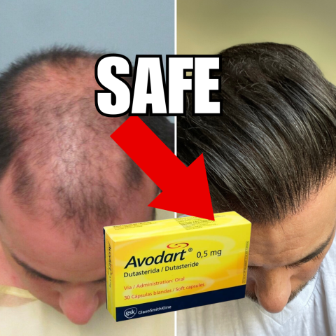 Is Dutasteride Safe For Hair Loss?