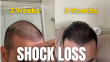 Hair Transplant Growth Stages (Ugly Duckling, Terrible Threes, Growth Phase, and Maturation) 